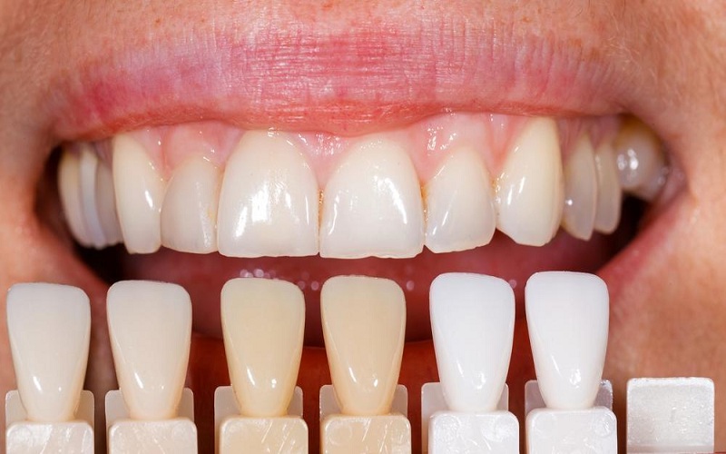 Porcelain Crowns: An Important Tool In Cosmetic Dentistry
