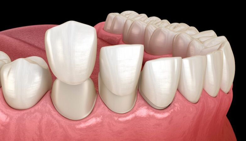 Tooth Replacement