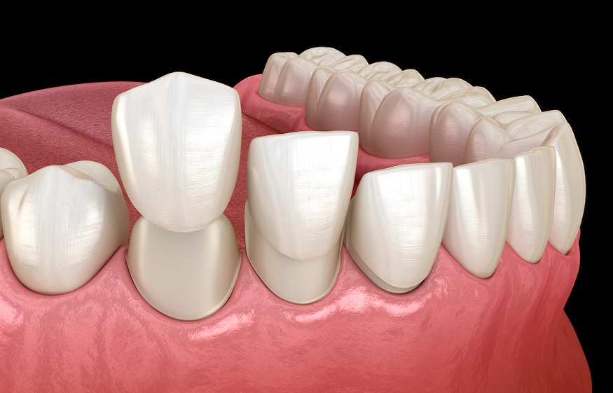 Understanding the Costs of Tooth Replacement