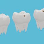 Understanding Cavities