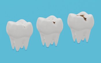 Understanding Cavities