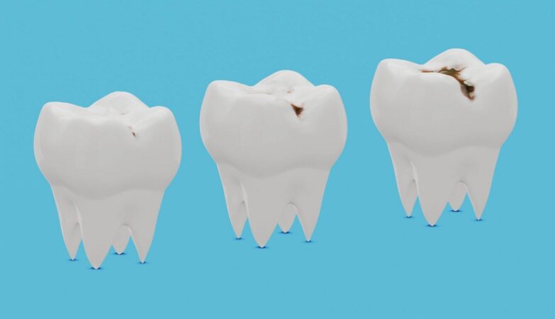 Understanding Cavities