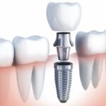 dental implants in Brooklyn, NY,