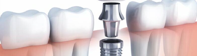 dental implants in Brooklyn, NY,