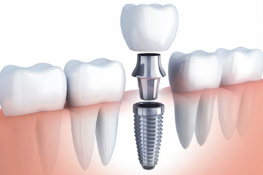 Why Choose Dental Implants? The Life-Changing Advantages