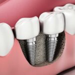 Archpoint Implant Dentistry