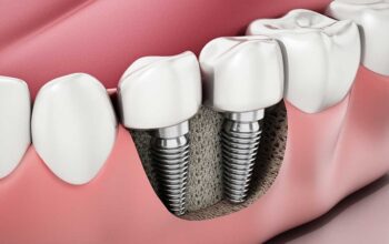 Archpoint Implant Dentistry