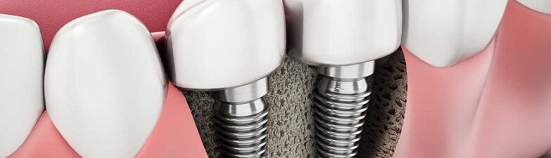 Archpoint Implant Dentistry