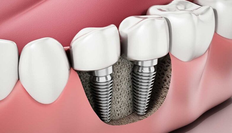 Archpoint Implant Dentistry