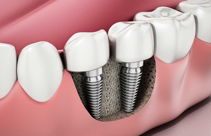 Restoring Confidence with Archpoint Implant Dentistry
